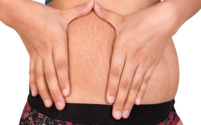 La clave para eliminar las estrías, celulitis y varices