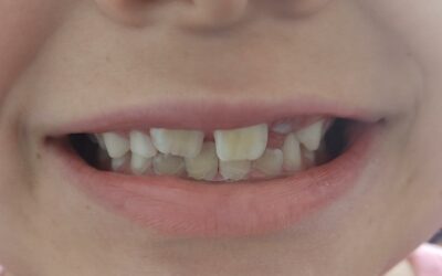 Durante los 3 primeros años de vida, es probable la aparición de anomalías en el esmalte dental