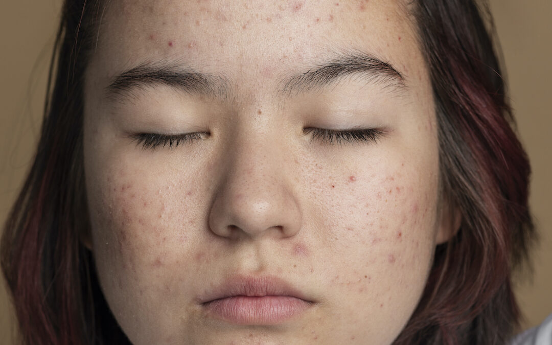 Investigación revela la importancia del equilibrio bacteriano en la piel para combatir el acné